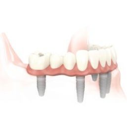 Implantología Dental